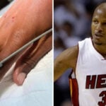 NBA – Ray Allen frôle le drame et termine à l’hôpital !