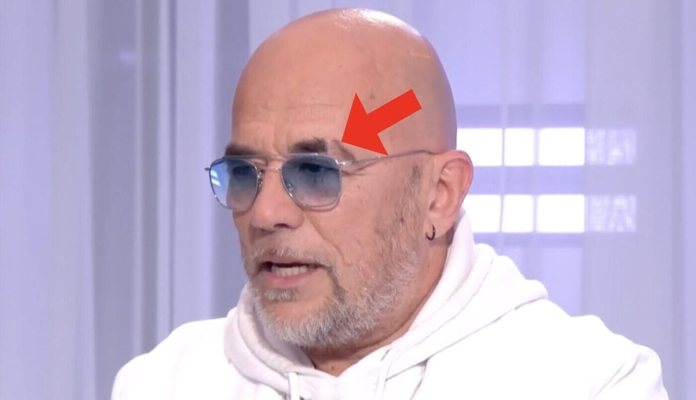 Pascal Obispo évoque sa cicatrice au sourcil